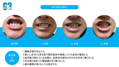 マウスピース369
