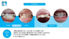 マウスピース369